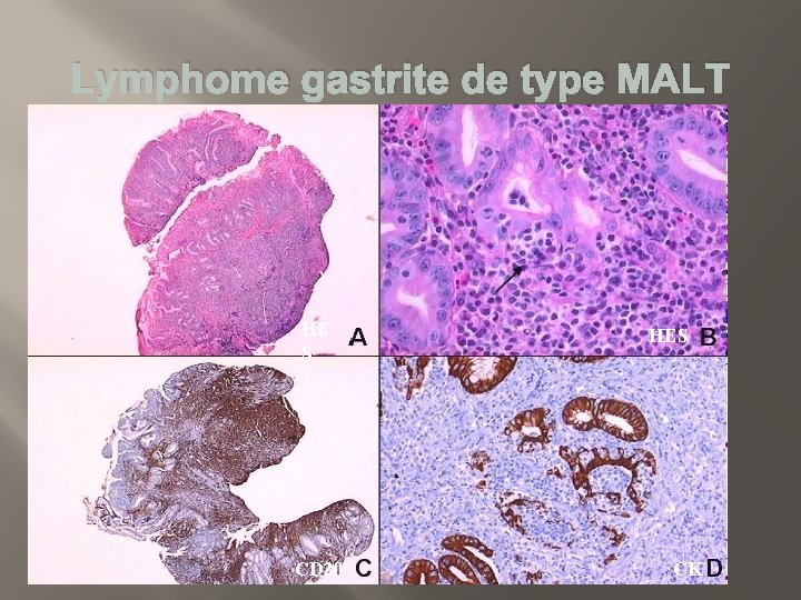 Lymphome gastrite de type MALT HE S CD 20 HES CK 