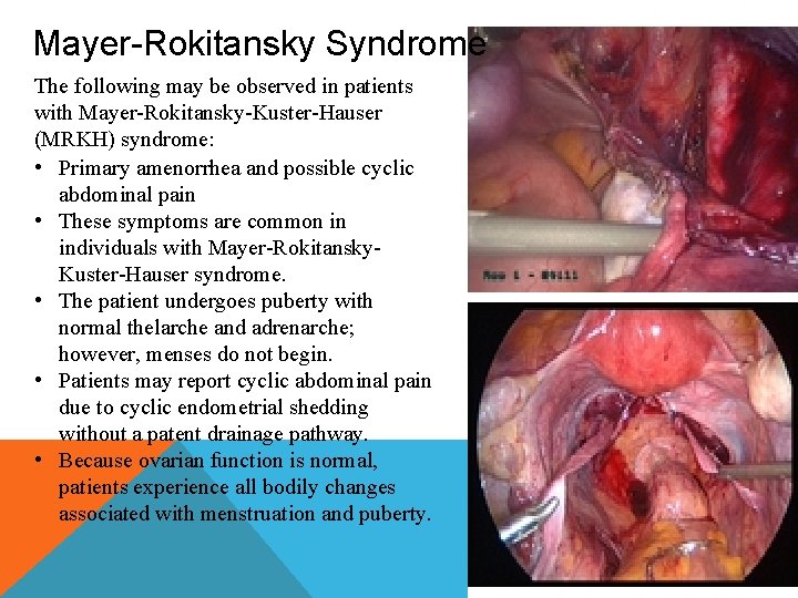 Mayer-Rokitansky Syndrome The following may be observed in patients with Mayer-Rokitansky-Kuster-Hauser (MRKH) syndrome: •