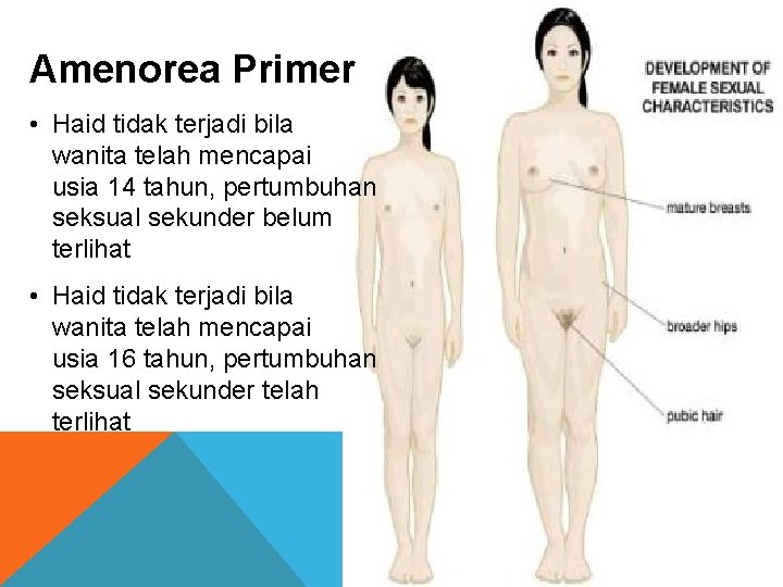 Amenorea Primer • Haid tidak terjadi bila wanita telah mencapai usia 14 tahun, pertumbuhan