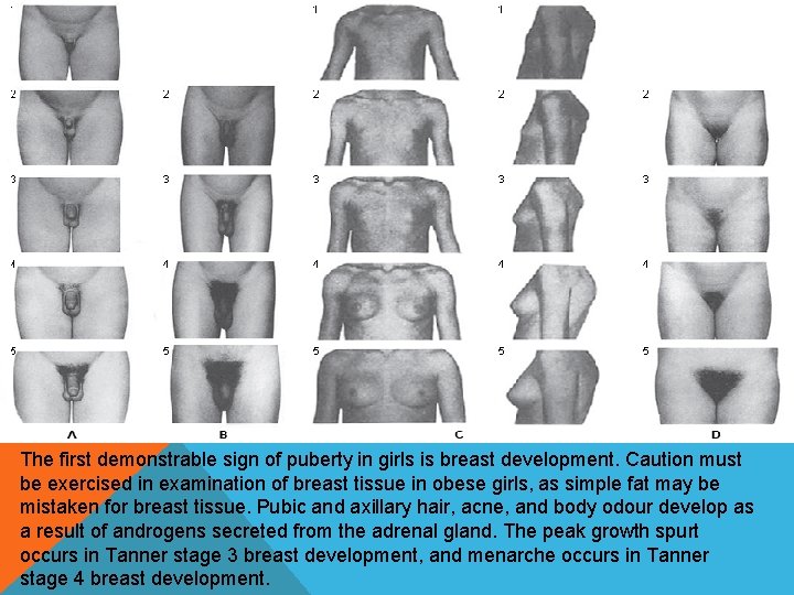 The first demonstrable sign of puberty in girls is breast development. Caution must be