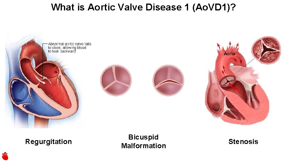 What is Aortic Valve Disease 1 (Ao. VD 1)? Regurgitation 1 Bicuspid Malformation Stenosis