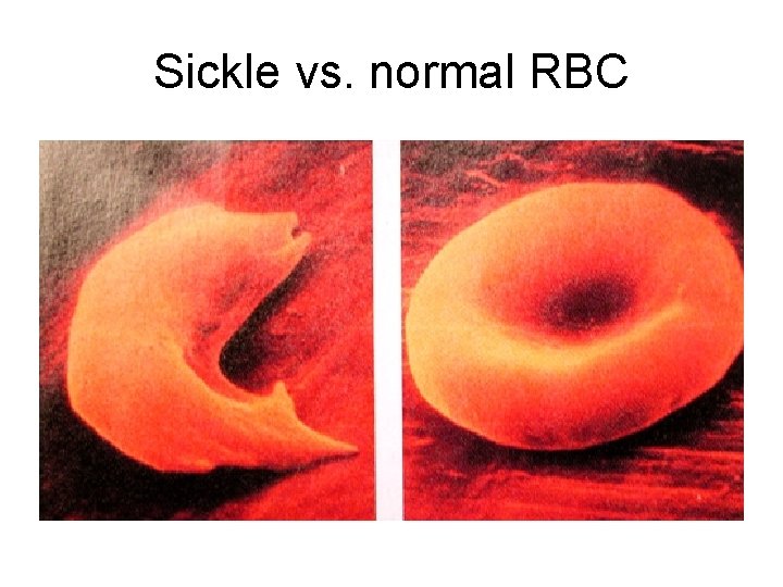 Sickle vs. normal RBC 