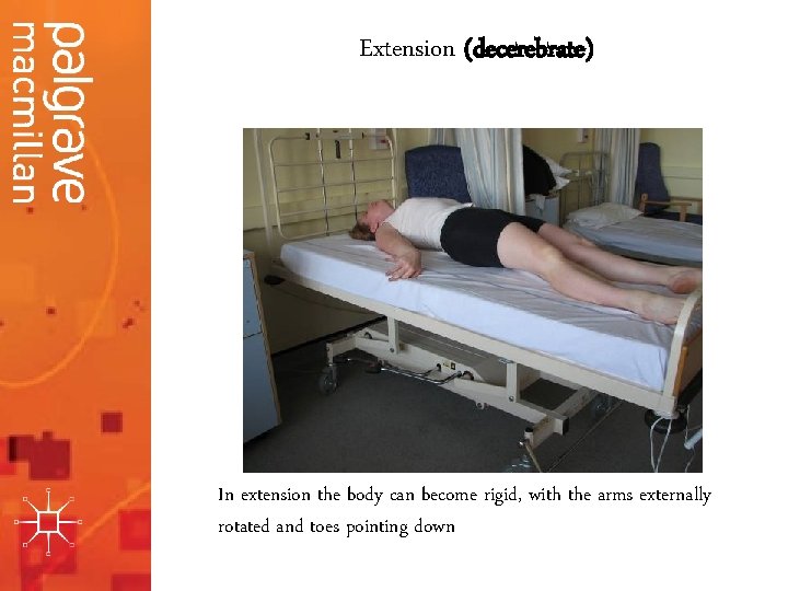 Extension (decerebrate) In extension the body can become rigid, with the arms externally rotated