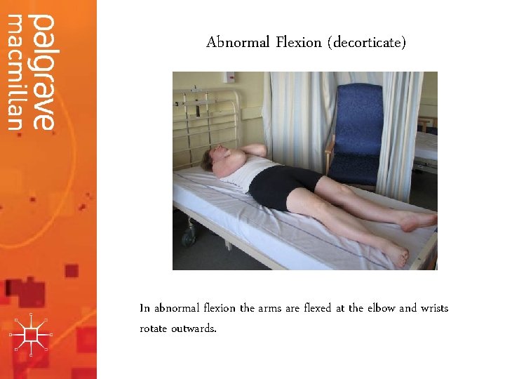 Abnormal Flexion (decorticate) In abnormal flexion the arms are flexed at the elbow and