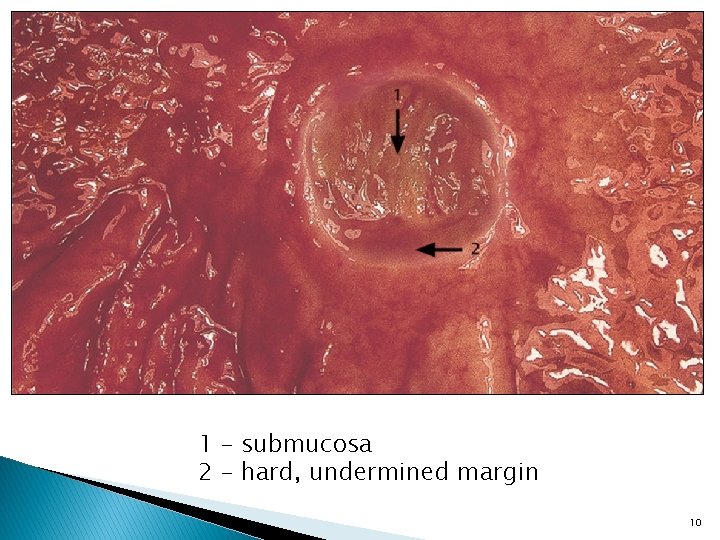 1 – submucosa 2 – hard, undermined margin 10 