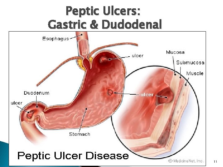 Peptic Ulcers: Gastric & Dudodenal 11 
