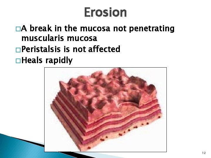 �A Erosion break in the mucosa not penetrating muscularis mucosa � Peristalsis is not