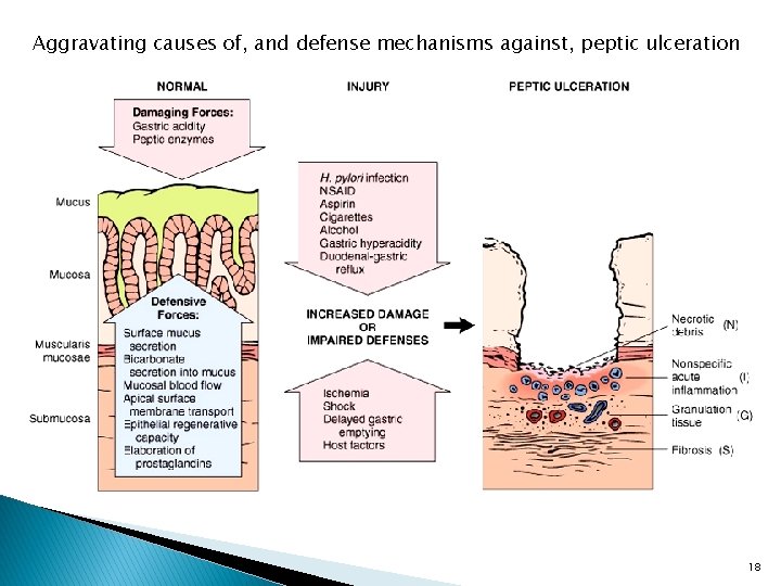 Aggravating causes of, and defense mechanisms against, peptic ulceration 18 