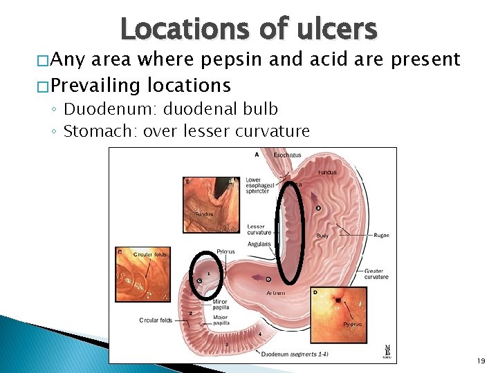 � Any Locations of ulcers area where pepsin and acid are present � Prevailing