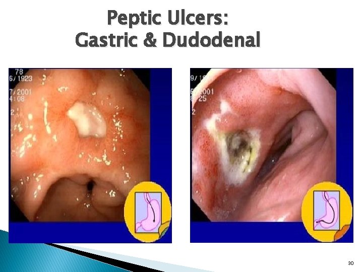 Peptic Ulcers: Gastric & Dudodenal 30 