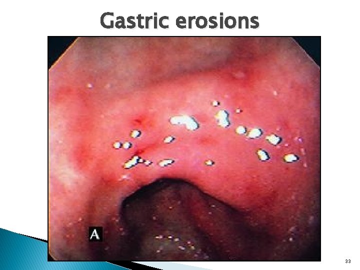 Gastric erosions 33 