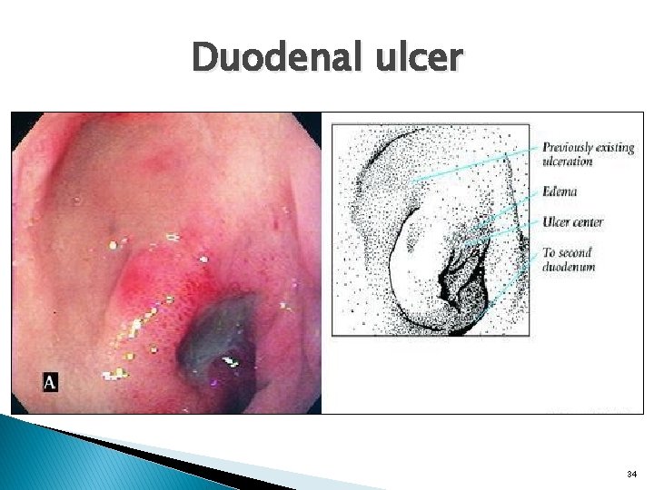 Duodenal ulcer 34 