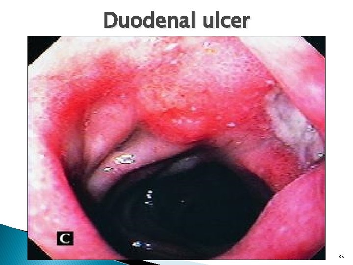 Duodenal ulcer 35 