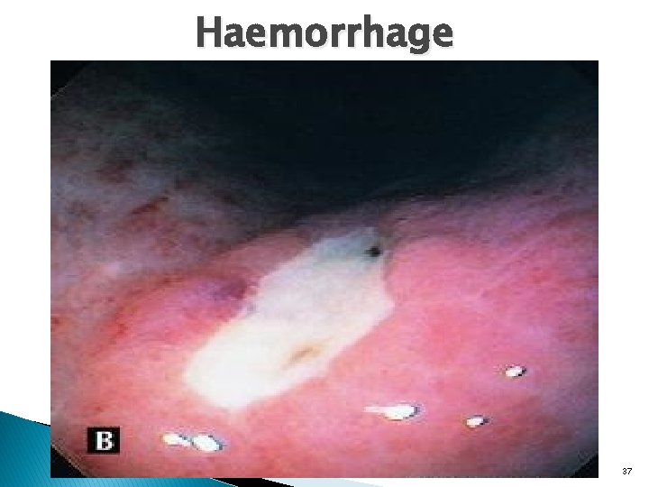 Haemorrhage 37 