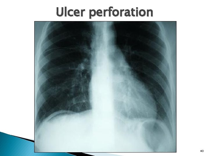 Ulcer perforation 40 