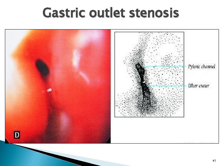 Gastric outlet stenosis 41 