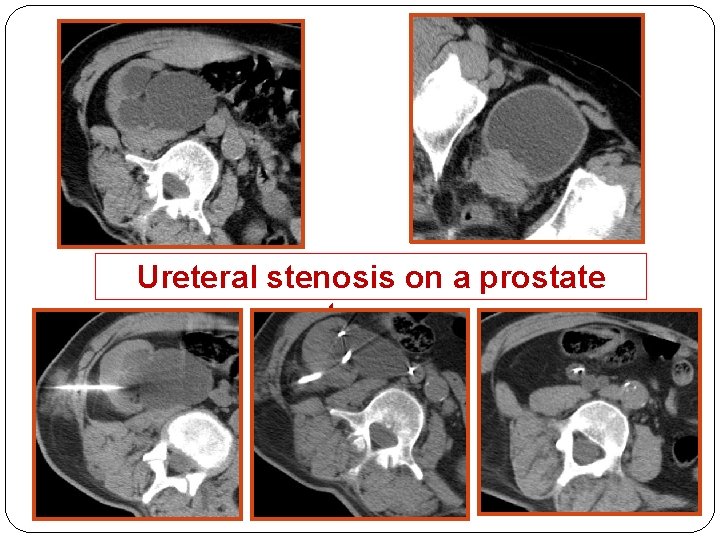 Ureteral stenosis on a prostate tumor 