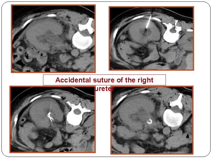 Accidental suture of the right ureter 