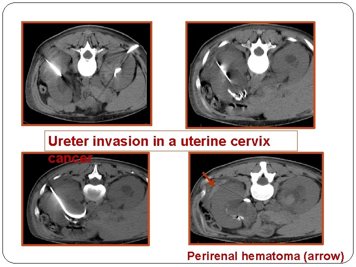 Ureter invasion in a uterine cervix cancer Perirenal hematoma (arrow) 