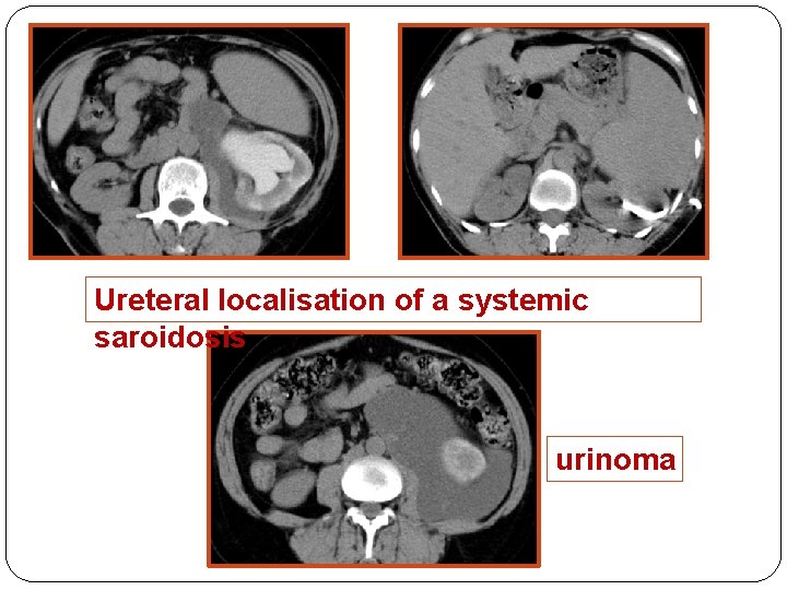 Ureteral localisation of a systemic saroidosis urinoma 