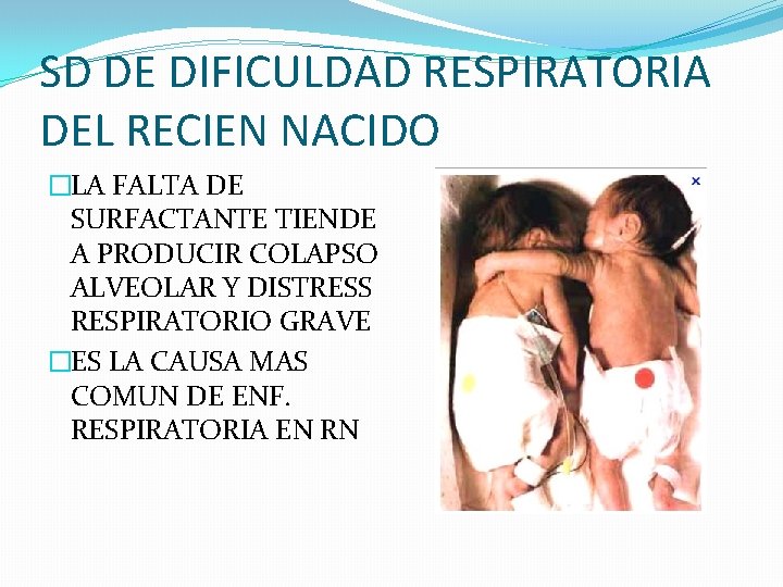 SD DE DIFICULDAD RESPIRATORIA DEL RECIEN NACIDO �LA FALTA DE SURFACTANTE TIENDE A PRODUCIR SD DE DIFICULDAD RESPIRATORIA DEL RECIEN NACIDO �LA FALTA DE SURFACTANTE TIENDE A PRODUCIR