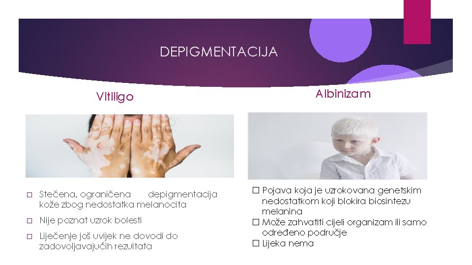 DEPIGMENTACIJA Vitiligo � Stečena, ograničena depigmentacija kože zbog nedostatka melanocita � Nije poznat uzrok