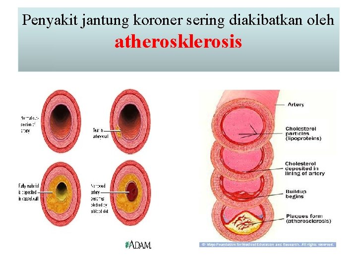 Penyakit jantung koroner sering diakibatkan oleh atherosklerosis 