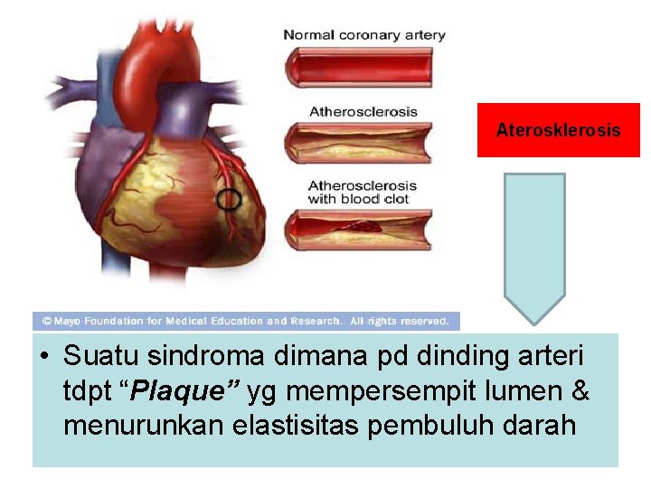 Aterosklerosis • Suatu sindroma dimana pd dinding arteri tdpt “Plaque” yg mempersempit lumen &