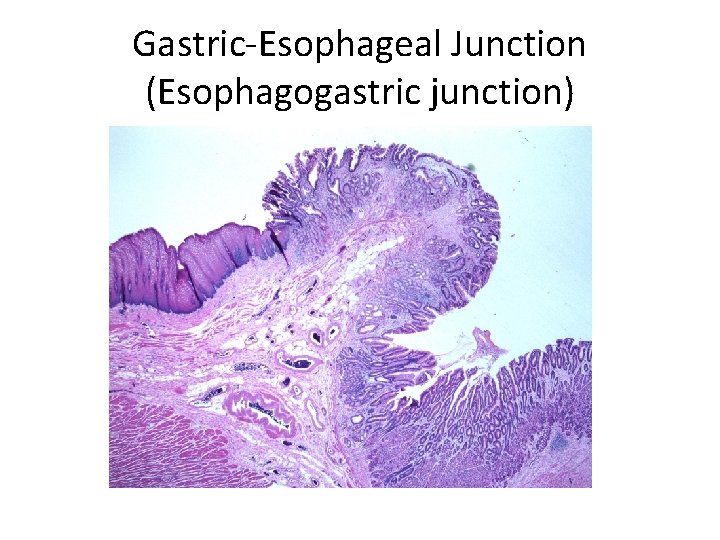 Gastric-Esophageal Junction (Esophagogastric junction) 