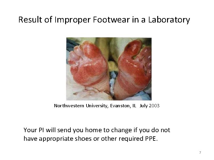 Result of Improper Footwear in a Laboratory Northwestern University, Evanston, IL July 2003 Your
