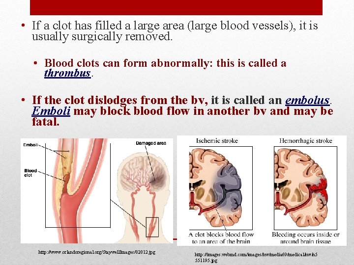  • If a clot has filled a large area (large blood vessels), it