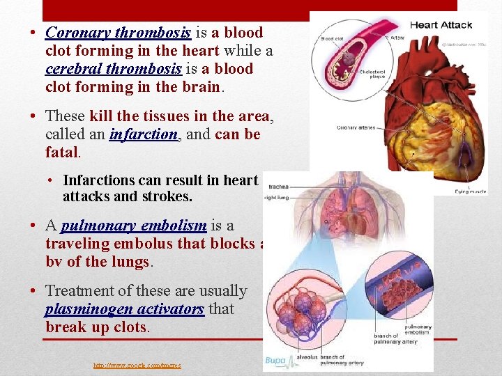  • Coronary thrombosis is a blood clot forming in the heart while a