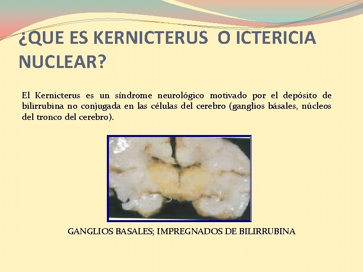 ¿QUE ES KERNICTERUS O ICTERICIA NUCLEAR? El Kernicterus es un síndrome neurológico motivado por ¿QUE ES KERNICTERUS O ICTERICIA NUCLEAR? El Kernicterus es un síndrome neurológico motivado por