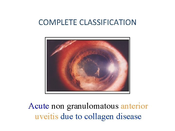 COMPLETE CLASSIFICATION Acute non granulomatous anterior uveitis due to collagen disease 