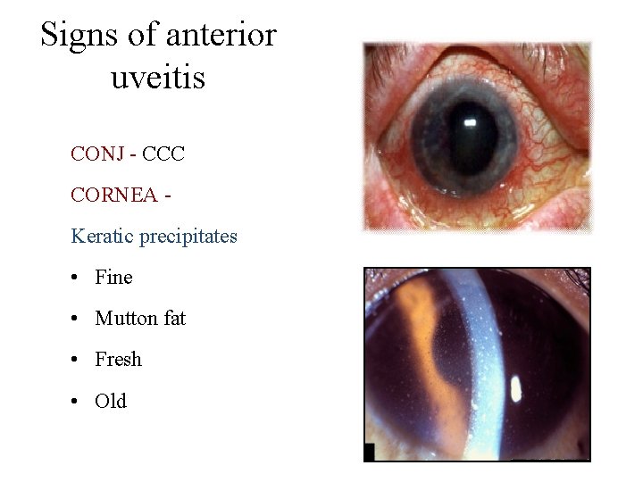 Signs of anterior uveitis CONJ - CCC CORNEA Keratic precipitates • Fine • Mutton