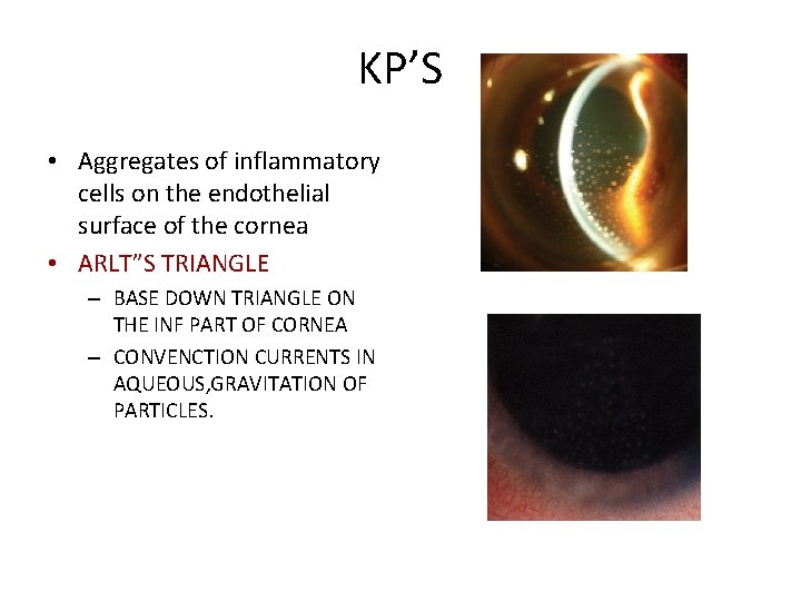 KP’S • Aggregates of inflammatory cells on the endothelial surface of the cornea •