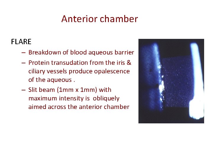 Anterior chamber FLARE – Breakdown of blood aqueous barrier – Protein transudation from the