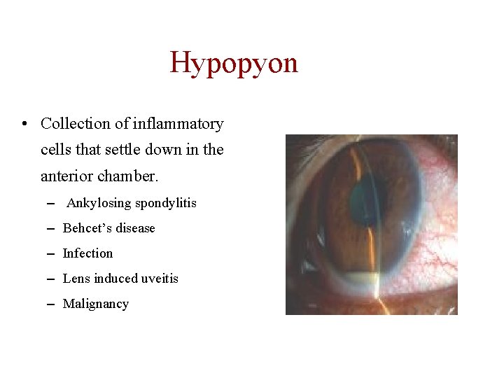 Hypopyon • Collection of inflammatory cells that settle down in the anterior chamber. –