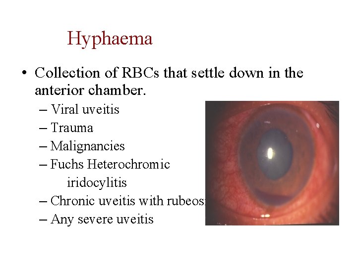 Hyphaema • Collection of RBCs that settle down in the anterior chamber. – Viral