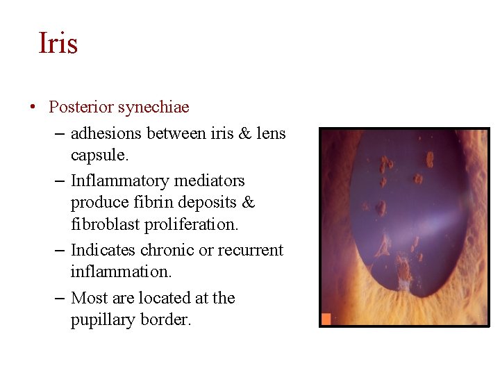 Iris • Posterior synechiae – adhesions between iris & lens capsule. – Inflammatory mediators