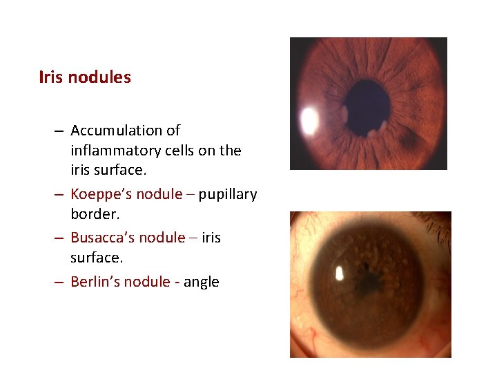 Iris nodules – Accumulation of inflammatory cells on the iris surface. – Koeppe’s nodule