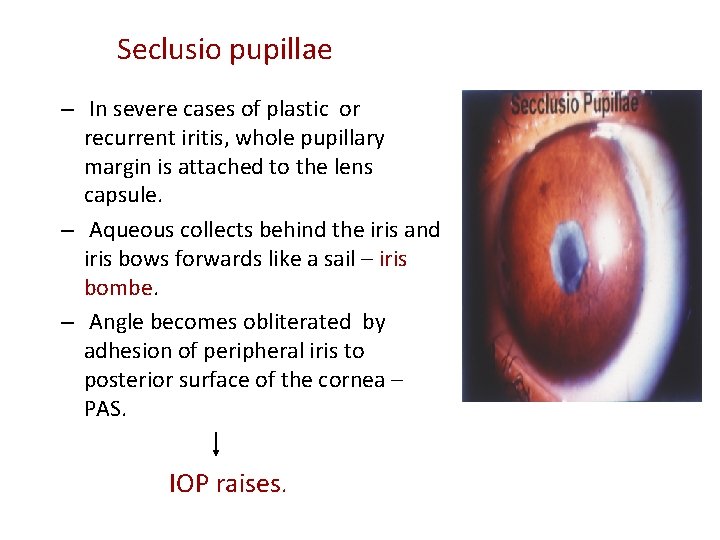 Seclusio pupillae – In severe cases of plastic or recurrent iritis, whole pupillary margin