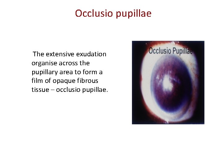Occlusio pupillae The extensive exudation organise across the pupillary area to form a film