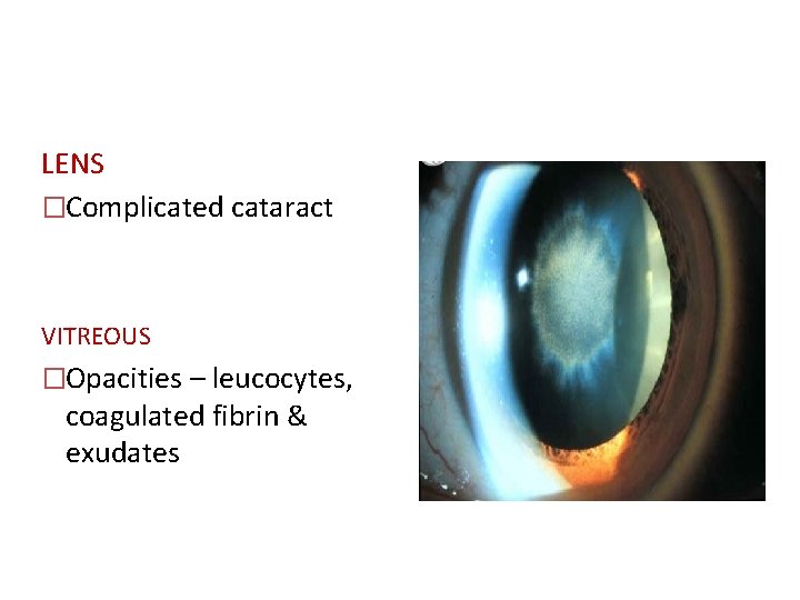 LENS �Complicated cataract VITREOUS �Opacities – leucocytes, coagulated fibrin & exudates 