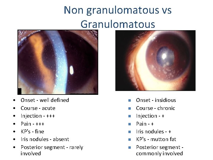 Non granulomatous vs Granulomatous • • Onset - well defined Course - acute Injection