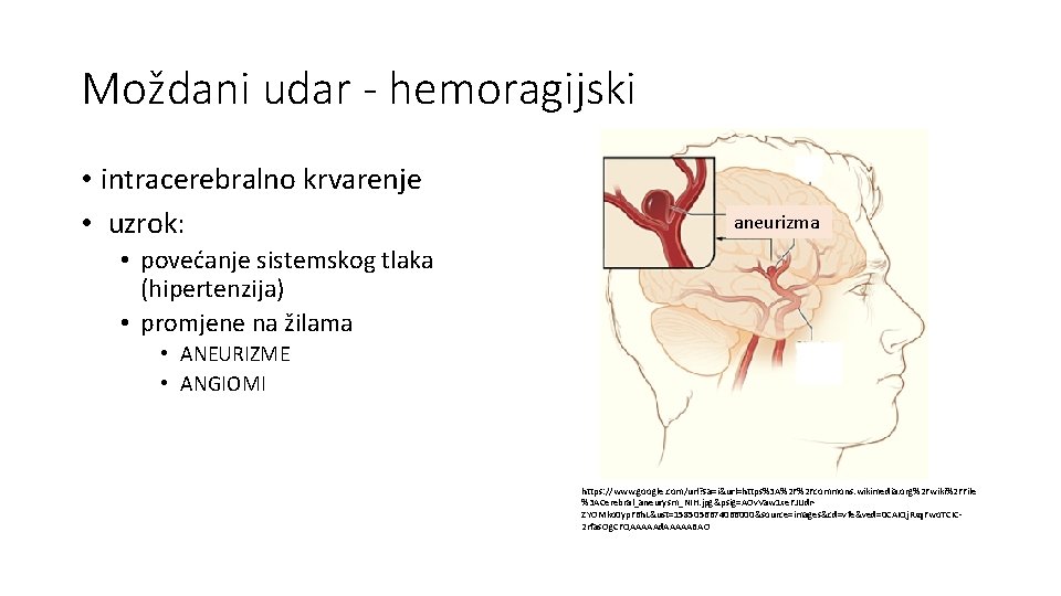 Moždani udar - hemoragijski • intracerebralno krvarenje • uzrok: aneurizma • povećanje sistemskog tlaka