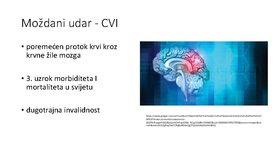 Moždani udar - CVI • poremećen protok krvi kroz krvne žile mozga • 3.