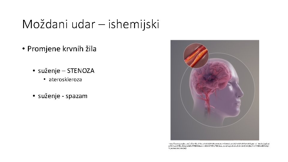 Moždani udar – ishemijski • Promjene krvnih žila • suženje – STENOZA • ateroskleroza