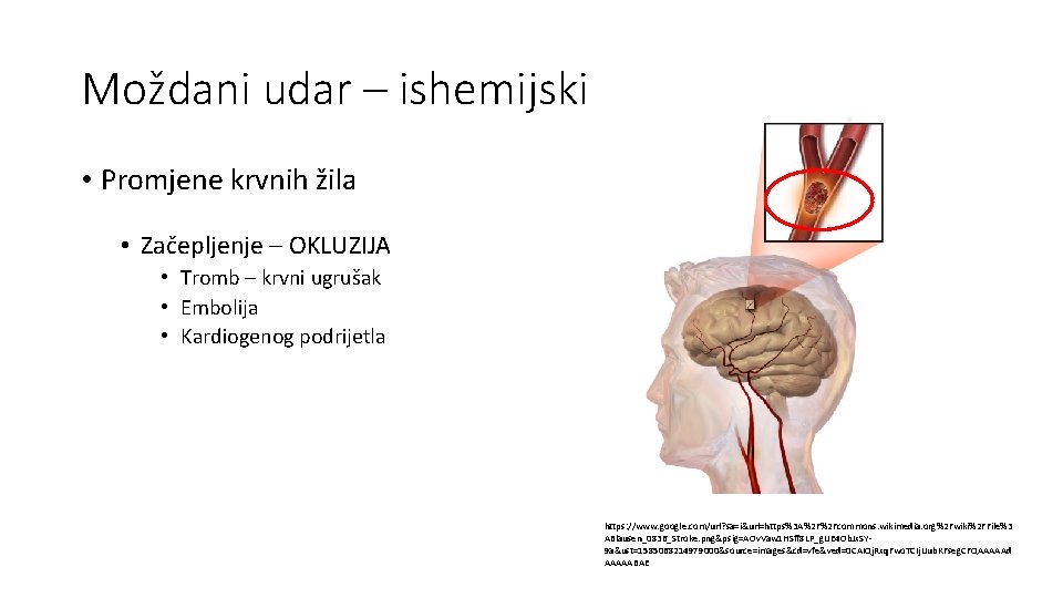 Moždani udar – ishemijski • Promjene krvnih žila • Začepljenje – OKLUZIJA • Tromb