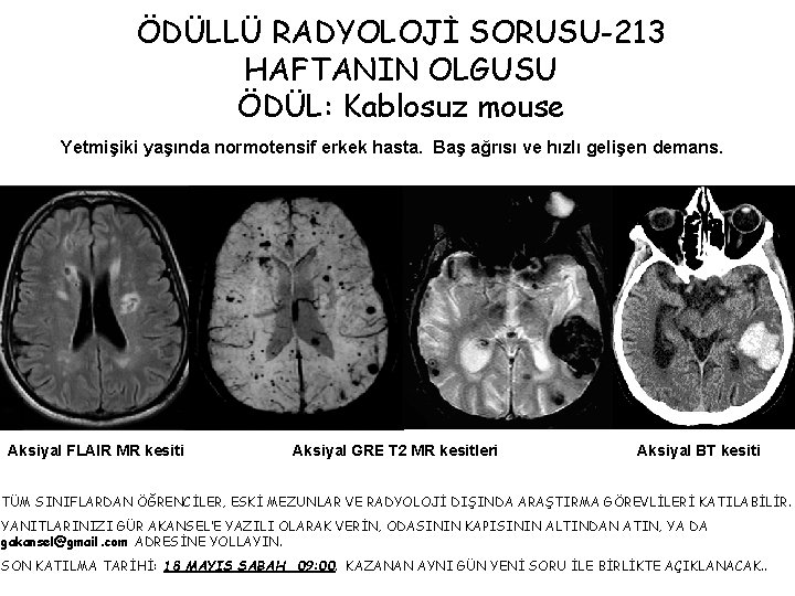 ÖDÜLLÜ RADYOLOJİ SORUSU-213 HAFTANIN OLGUSU ÖDÜL: Kablosuz mouse Yetmişiki yaşında normotensif erkek hasta. Baş